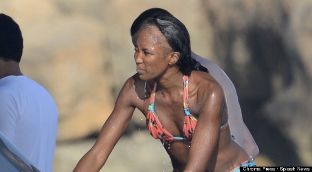 Read more about the article Traction Alopecia in Naomi Campbell